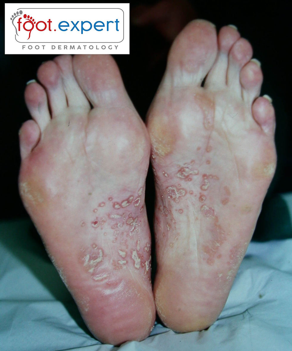 Pustules on the arch of the foot