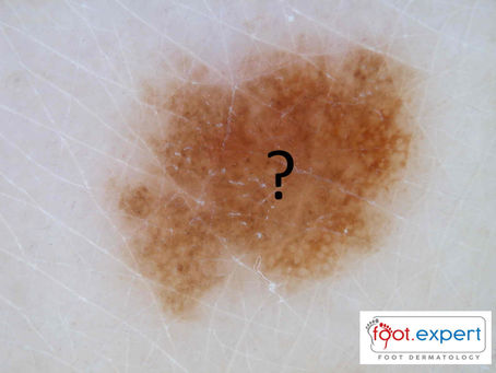 The mystery of moles