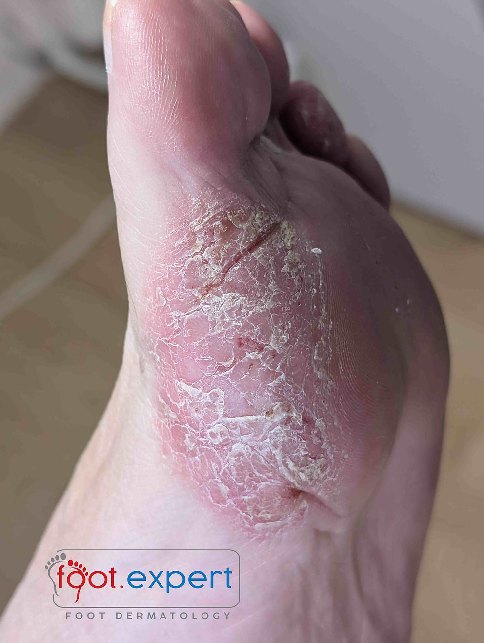 An image of a patch of eczema on a persons foot