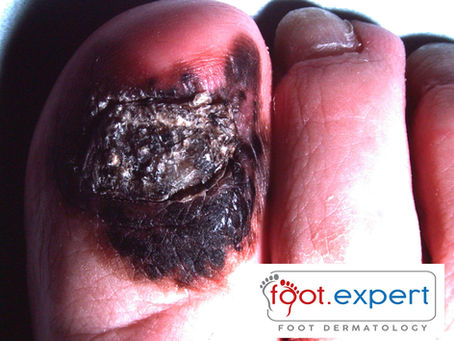 An advanced melanoma on the big toe of a person