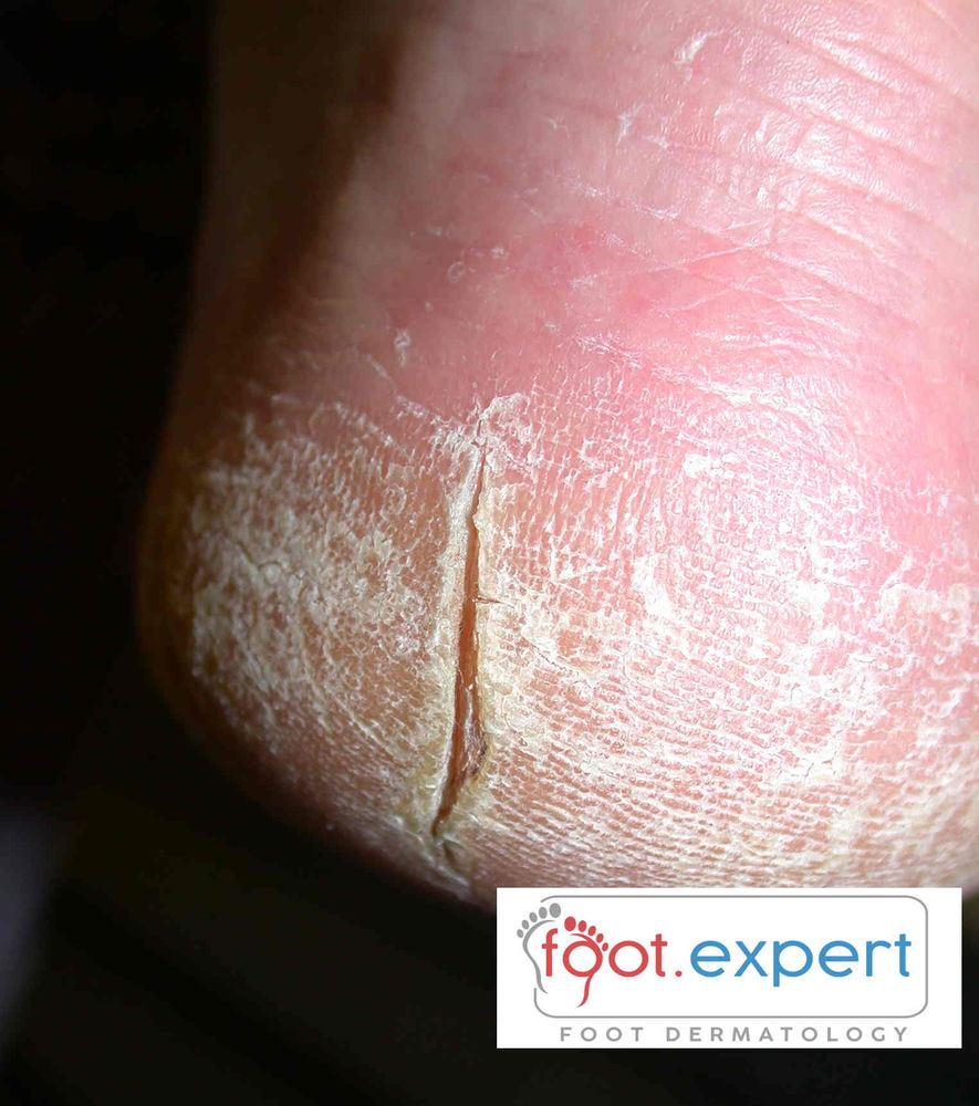 BetaBlockers for Heel Fissures