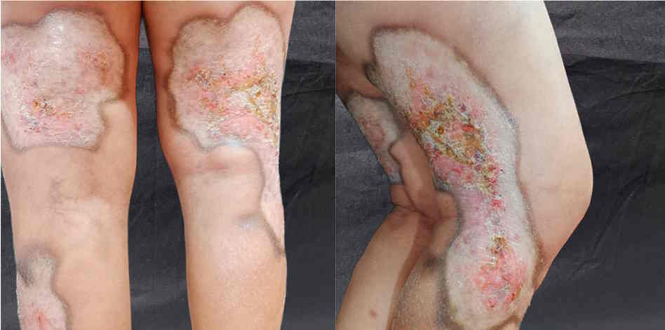 Lichen Sclerosus affecting the legs.