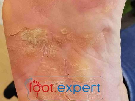 Keratoderma Climactericum – another cause of plantar hyperkeratosis