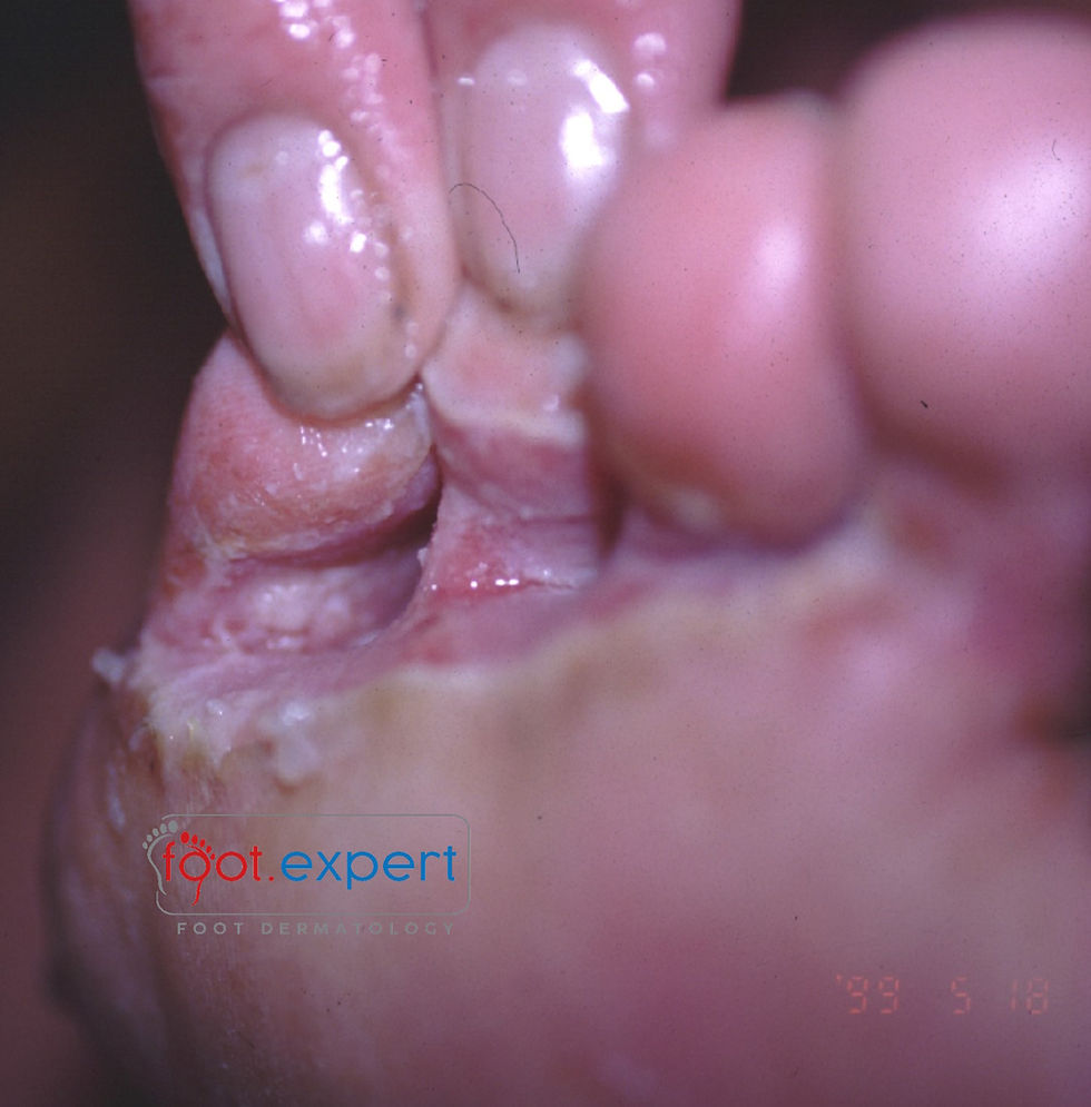 Infective Intertrigo - a step on from tinea pedis