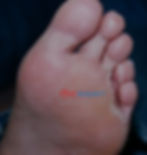 A picture of the sole of the foot with scaling due to tinea pedis between the toes.