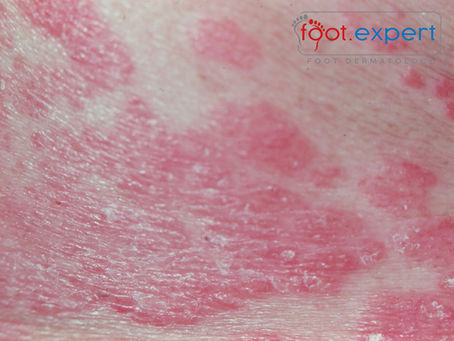 A plaque of Psoriasis