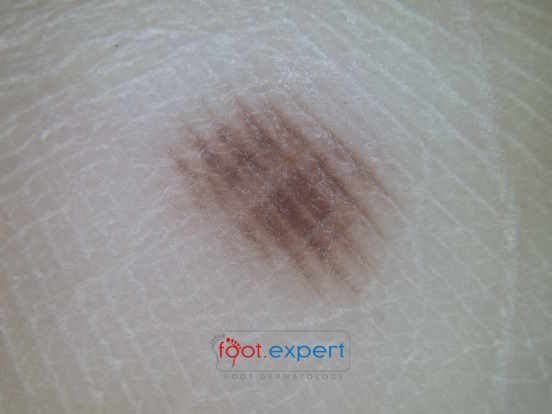 Cases in Dermoscopy with Dr Stephen Hayes