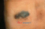 A melanoma on the sole of the foot.