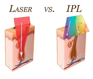 Ipl Vs Laser Hair Removal