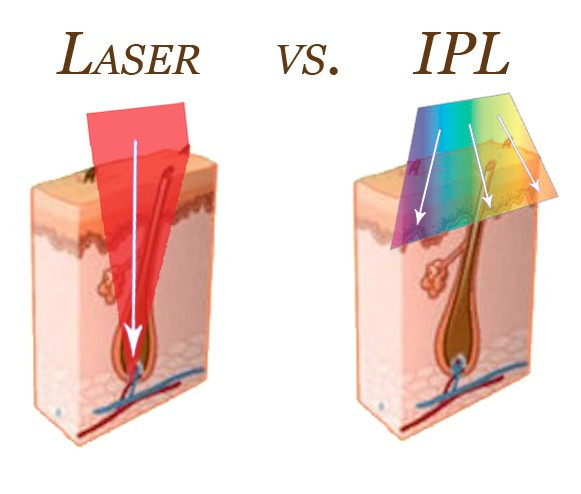 IPL vs. Laser - Laser Solutions by Kaylee - Laser Hair Removal - Beecaves - Hill Country Galleria - Lakeway