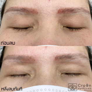ลบคิ้วด้วยเลเซอร์ ทางเลือกสำหรับผู้ที่ต้องการลบรอยสักคิ้ว