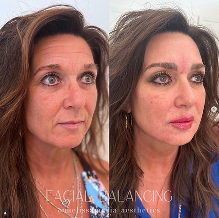 Facial balancing using biostimulators like sculptra and radiesse in Raleigh NC

