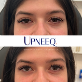 hooded eyes before and after