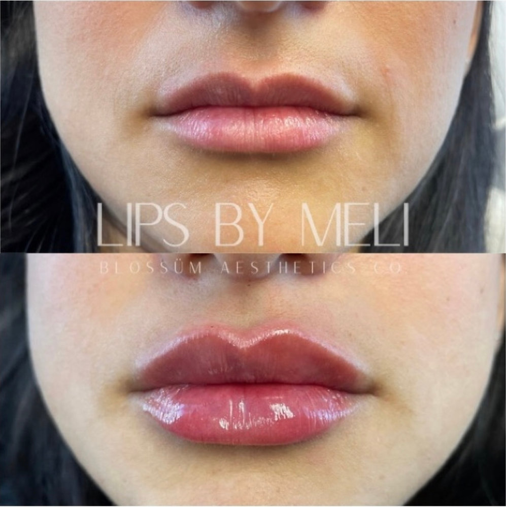How long does lip filler last?