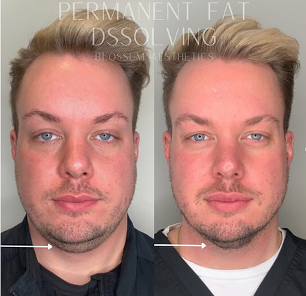 KYBELLA Treatment for permanent fat loss in Raleigh NC