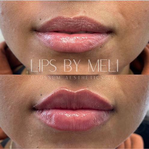 Lip filler before and after with Juvederm