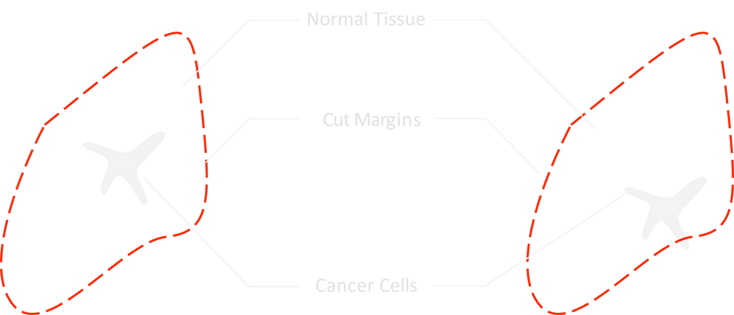 Tumor Margin Graphic.png