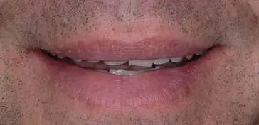 Before Kor Teeth Whitening and Porcelain Veneers