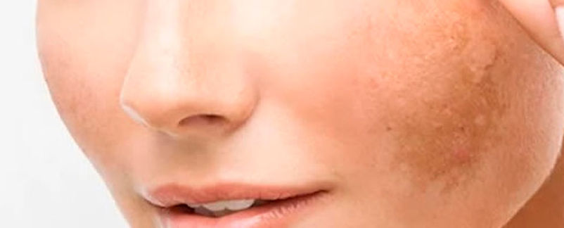 Melasma en el rostro