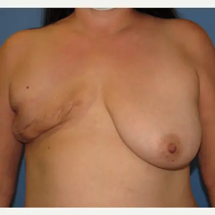 This patient desired DIEP flap reconstruction for both breasts