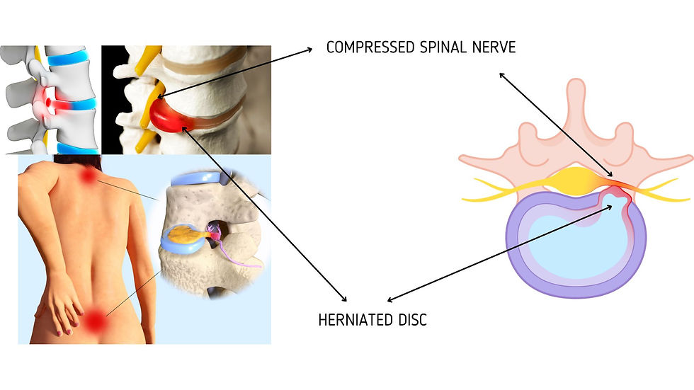 Slipped Disc Unmasked Identifying Symptoms and Exploring Treatment