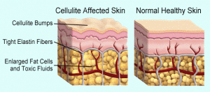 cellulite-treatment-300x132