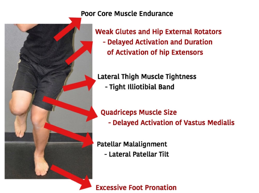 Patellofemoral Pain Syndrome (PFPS) in Soccer Players