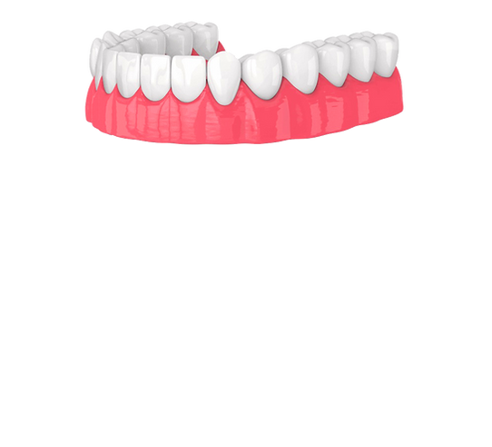 3d Illustration of prosthetic part of all on 4 implantation - alo.dr