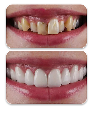 Gum contouring.png