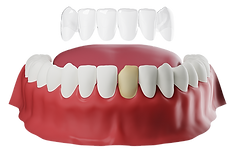 Dental-venners-3.png