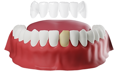 Dental-venners-3.png
