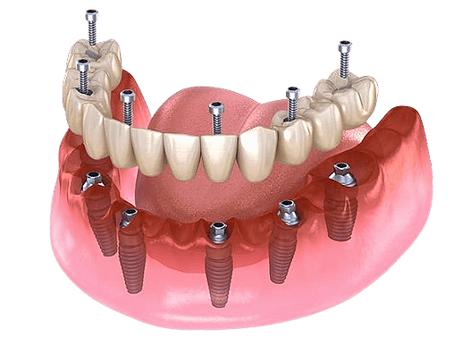 all-on-6-dental-implants-costa-rica_edit