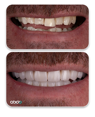 Smile makeover 4.png