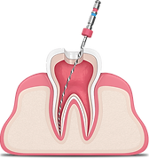 root-canal-graphic.png