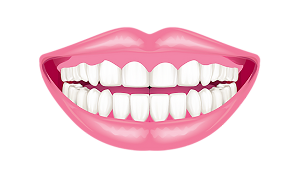 3D illustration of Gum contouring treatment in Georgia