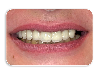 After dental bridge in Georgia – restored smile with zirconia bridge