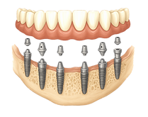 implants-all-on-6-dentics_edited.png