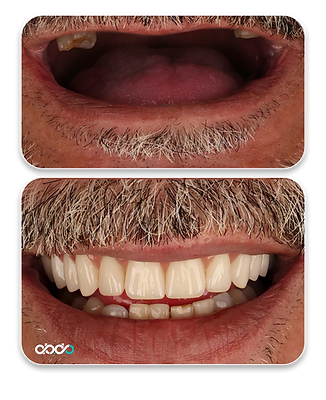 Before and after All-on-6 procedure in Tbilisi – lifetime guarantee