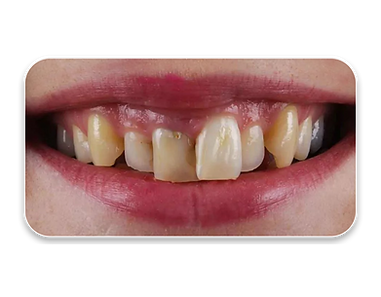 Before gum contouring treatment photo in Georgia