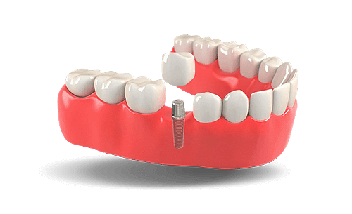 dental-implants_edited.png