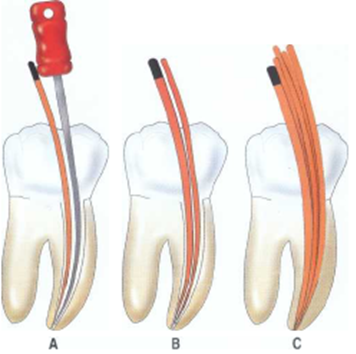 Ενδοδοντική Θεραπεία ( Απονεύρωση) - Root Canal Therapy