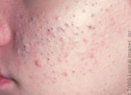 acne-grade1.PNG