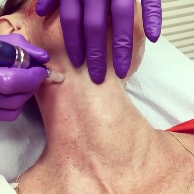 microneedling for skin tightening