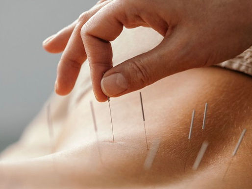 L'Acupuncture aide à réduire le stress