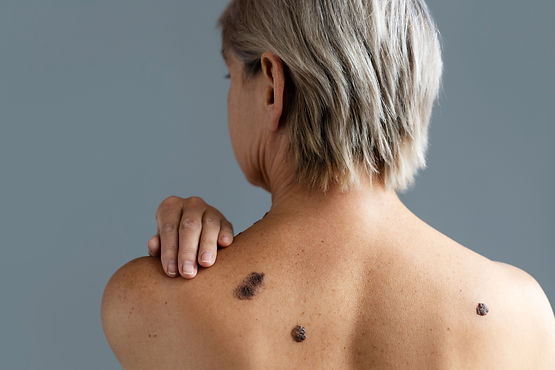 back-view-woman-with-skin-cancer_edited.jpg