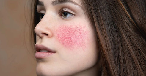 Rosacea-Compreendendo-e-Gerenciando-uma-Condicao-Comum-da-Pele-1-scaled.jpg