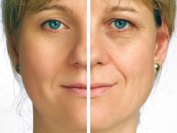 botox-injections-Mini-Face-Lift-8-1200x900.png