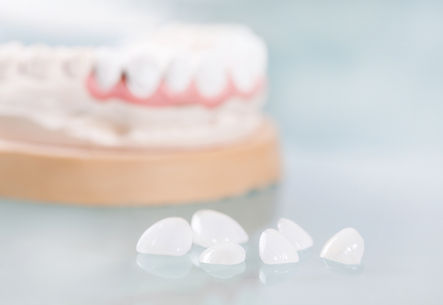 Dental veneers are lying on a blue backg