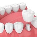 MedforLess dental crown bridge dental service