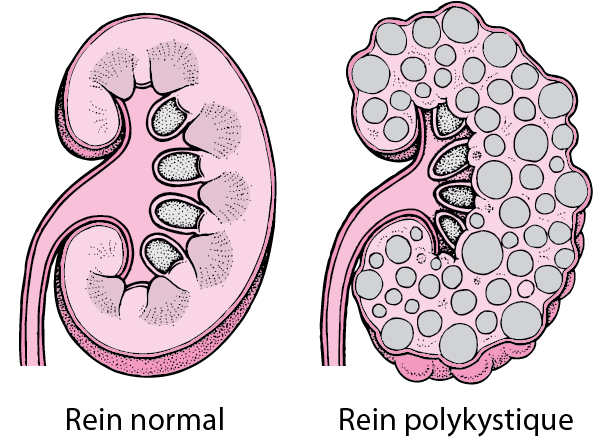 KID_polycystic_kidney_fr.gif